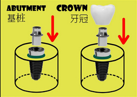 种植牙基桩与牙冠